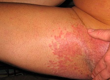 psoriasis before